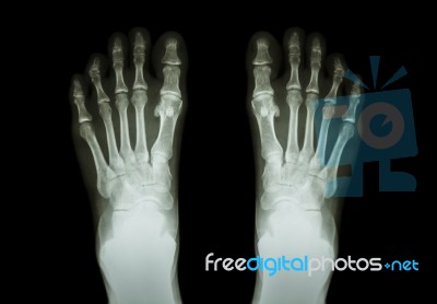 Film X-ray Both Foot ( Front View ) Stock Photo