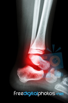 Film X-ray Child's Ankle And Arthritis At Ankle (rheumatoid) Stock Photo