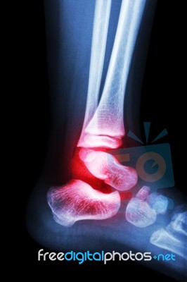 Film X-ray Child's Ankle And Arthritis At Ankle (rheumatoid) Stock Photo