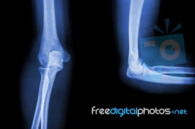 Film X-ray Elbow Ap(antero-posterior)/lateral Stock Photo