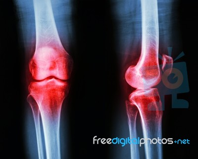 Film X-ray Knee Ap/lateral : Osteoarthritis Knee (inflammation At Knee) Stock Photo
