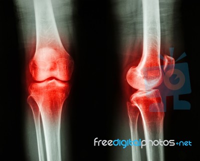 Film X-ray Knee Ap/lateral : Osteoarthritis Knee (inflammation At Knee) Stock Photo