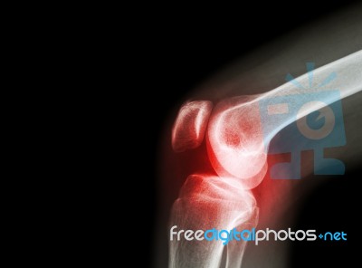 Film X-ray Knee Joint With Arthritis ( Gout , Rheumatoid Arthritis , Septic Arthritis , Osteoarthritis Knee ) And Blank Area At Left Side Stock Photo