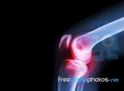 Film X-ray Knee Joint With Arthritis ( Gout , Rheumatoid Arthritis , Septic Arthritis , Osteoarthritis Knee ) And Blank Area At Left Side Stock Photo