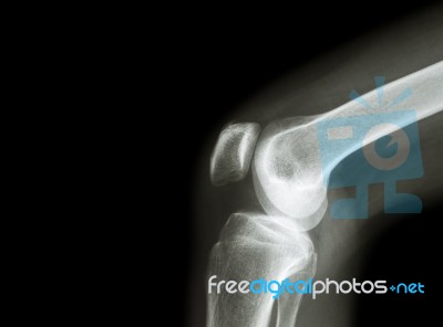 Film X-ray Knee Joint With Arthritis ( Gout , Rheumatoid Arthritis , Septic Arthritis , Osteoarthritis Knee ) And Blank Area At Left Side Stock Photo