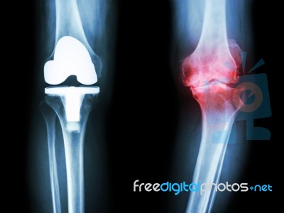 Film X-ray Knee Of Osteoarthritis Knee Patient And Artificial Joint Stock Photo
