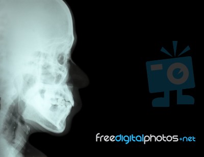 Film X-ray Lateral Nasal Bone ( Side View Of Skull ) And Blank Area At Right Side Stock Photo