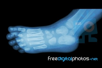 Film X-ray Of Child 's Foot ( Side View ) ( Lateral ) Stock Photo
