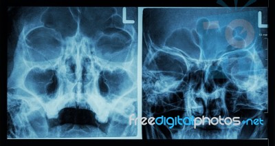 Film X-ray Paranasal Sinus Show Frontal Sinus , Maxillary Sinus , Ethmoid Sinus Stock Photo