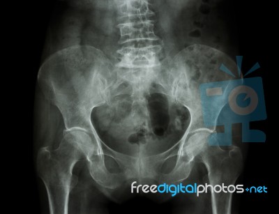 Film X-ray Pelvis Of Osteoporosis Patient Stock Photo