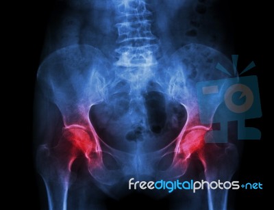 Film X-ray Pelvis Of Osteoporosis Patient And Arthritis Both Hip… Stock Photo