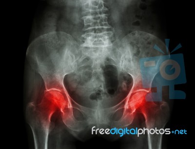 Film X-ray Pelvis Of Osteoporosis Patient And Arthritis Both Hip… Stock Photo
