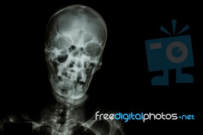 Film X-ray Skull And Blank Area At Right Side Stock Photo