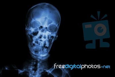 Film X-ray Skull And Blank Area At Right Side Stock Photo