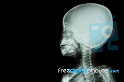 Film X-ray Skull And Body Of Child ( Blank Area At Left Side ) Stock Photo