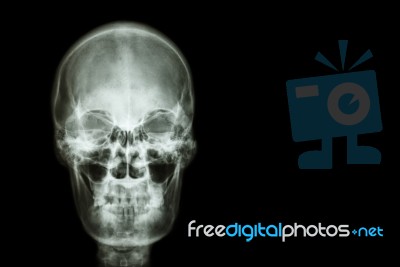 Film X-ray Skull Of Human And Blank Area At Right Side ( Medical , Science And Healthcare Concept And Background ) Stock Photo
