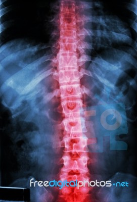 Film X-ray T-l Spine(thoracic-lumbar Spine) Show : Human's Thoracic-lumbar Spine And Inflammation At Spine Stock Photo