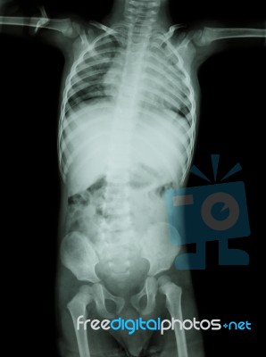 Film X-ray Whole Body Of Child ( Medical , Science And Healthcare Concept ) Stock Photo