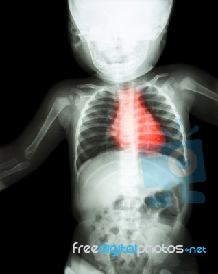 Film X-ray Whole Child 's Body With Heart Disease ( Rheumatic Heart Disease , Valvular Heart Disease ) ( Cardiovascular System ) Stock Photo