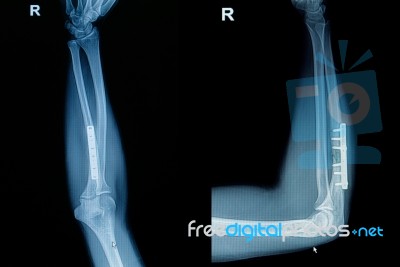 Film X-ray Wrist Fracture With Plate And Screw Stock Photo