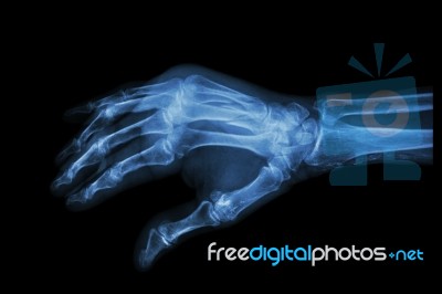 Fracture At 3rd And 4th Metacarpal Bone Stock Photo