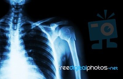 Fracture At Neck Of Humerus ( Arm Bone ) ( Film X-ray Left Shoulder And Blank Area At Right Side ) Stock Photo