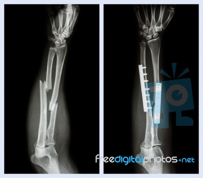Fracture Both Bone Of Forearm. It Was Operated And Internal Fixed With Plate And Screw (left Image : Before Operation , Right Image : After Operation) Stock Photo