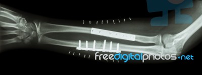 Fracture Both Bone Of Forearm ( Ulnar And Radius ) .  It Was Operated And Internal Fixed By Plate And Screw Stock Photo