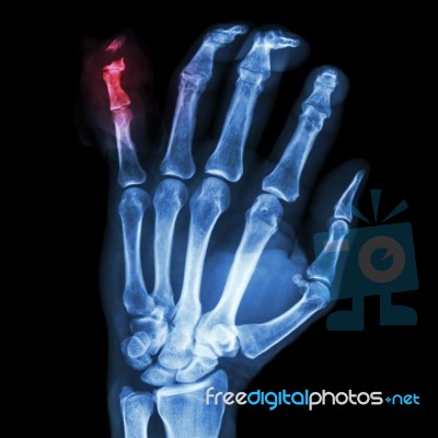 Fracture Distal Pharange Little Finger Stock Photo