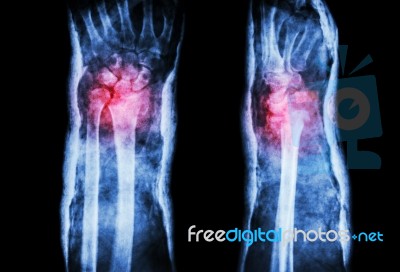 Fracture Distal Radius (colles' Fracture) And Cast (front & Side) Stock Photo