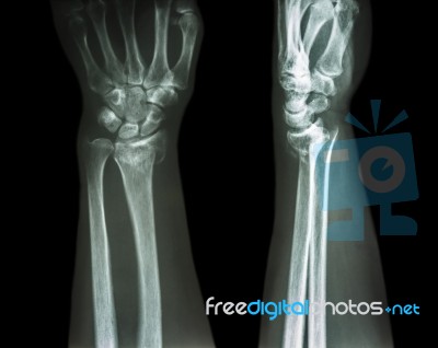 Fracture Distal Radius (colles' Fracture) (wrist Broken) Stock Photo