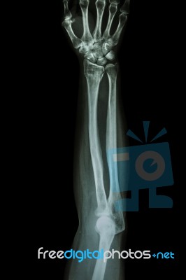 Fracture Distal Radius (wrist Bone) ,(colles' Fracture) Stock Photo