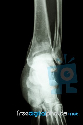 Fracture Distal Tibia And Fibula (leg's Bone) Stock Photo