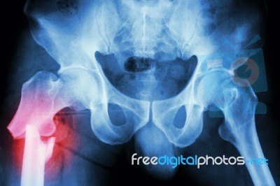 Fracture Right Femur (thigh's Bone) Stock Photo