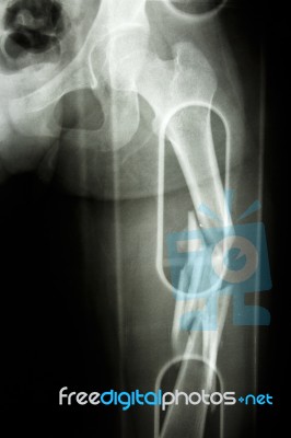 Fracture Shaft Of Femur Stock Photo