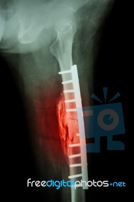 Fracture Shaft Of Femur. It Was Operated And Internal Fixation B… Stock Photo