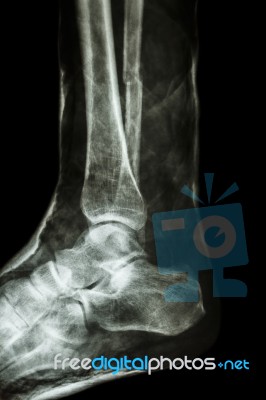 Fracture Shaft Of Fibula(leg's Bone) With Cast Stock Photo