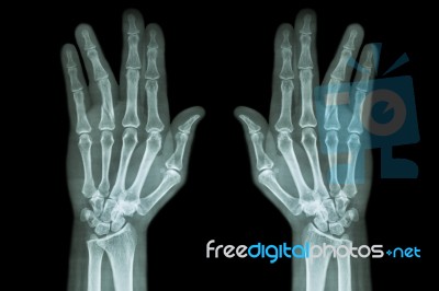 Fracture Shaft Of Proximal Phalange Of Ring Finger ( Film X-ray Both Hand Ap ) Stock Photo