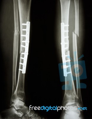 Fracture Shaft Of Tibia And Fibula Stock Photo