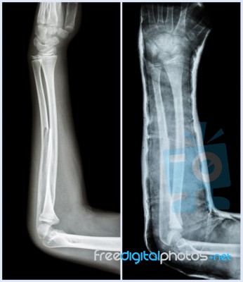Fracture Shaft Of Ulnar Bone ( Forearm Bone )  : ( Left : Pre-treatment  ,  Right : Psot-treatment (splint With Cast) ) Stock Photo