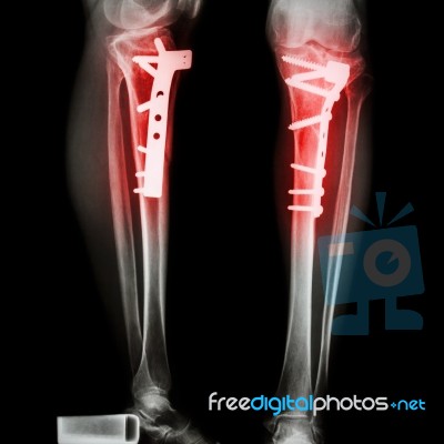 Fracture Tibia(leg Bone) Stock Photo