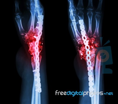 Fracture Wrist And Chronic Infection. It Was Operated And Intern… Stock Photo