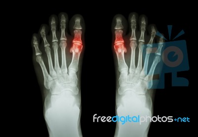 Gout , Rheumatoid Arthritis ( Film X-ray Both Foot And Arthritis At First Metatarsophalangeal Joint ) ( Medicine And Science Background ) Stock Photo