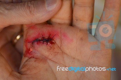 Hand Injury Stock Photo