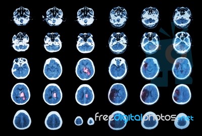 Hemorrhagic Stroke And Ischemic Stroke .  Ct Scan Of Brain : Intracerebral Hemorrhage ( 3 Left Column , Cerebral Infarction ( 3 Right Column )) ( Medical And Science Background ) Stock Photo
