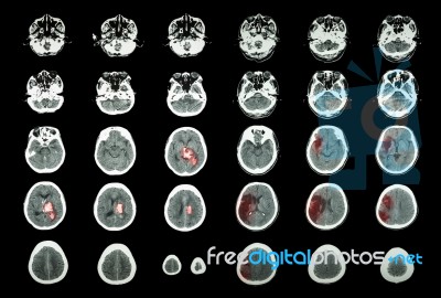 Hemorrhagic Stroke And Ischemic Stroke .  Ct Scan Of Brain : Intracerebral Hemorrhage ( 3 Left Column , Cerebral Infarction ( 3 Right Column )) ( Medical And Science Background ) Stock Photo
