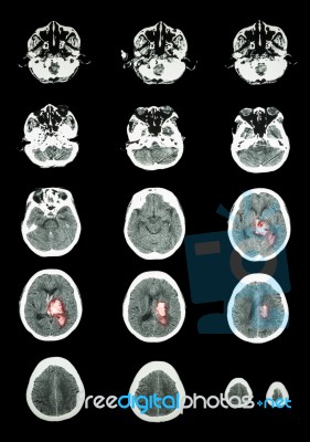 Hemorrhagic Stroke .  Ct Scan (computed Tomography) Of Brain ( C… Stock Photo