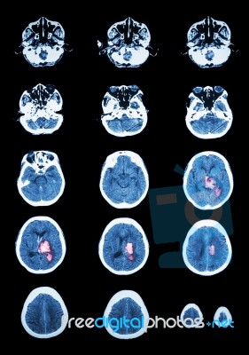 Hemorrhagic Stroke . Ct Scan (computed Tomography) Of Brain ( C… Stock Photo Hemorrhagic Stroke . Ct Scan (computed Tomography) Of Brain ( C… Stock Photo