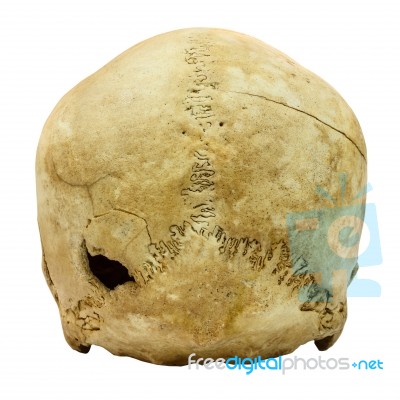 Human Skull Fracture (backside)  (mongoloid,asian) On Isolated B… Stock Photo