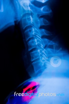 Imaging Of Spinal Column Stock Photo